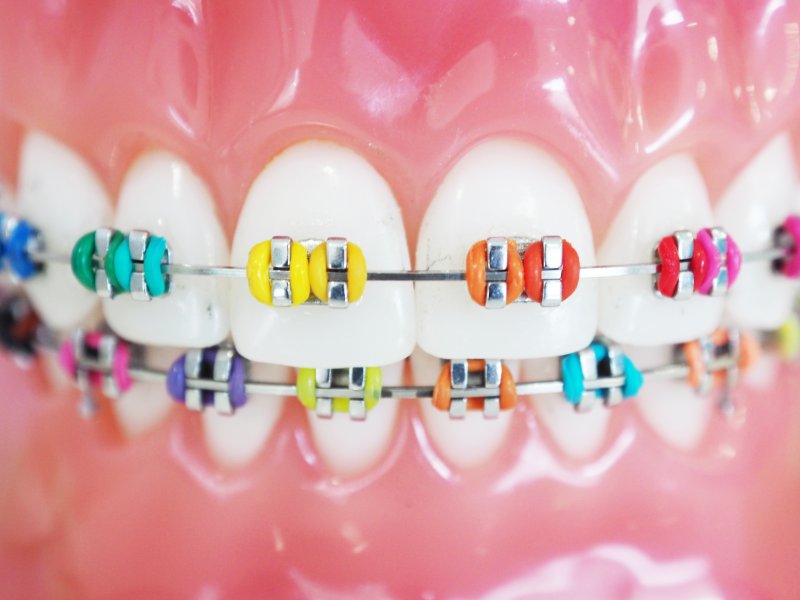 Rubber Bands For Braces: Helpful Tips And Tricks
