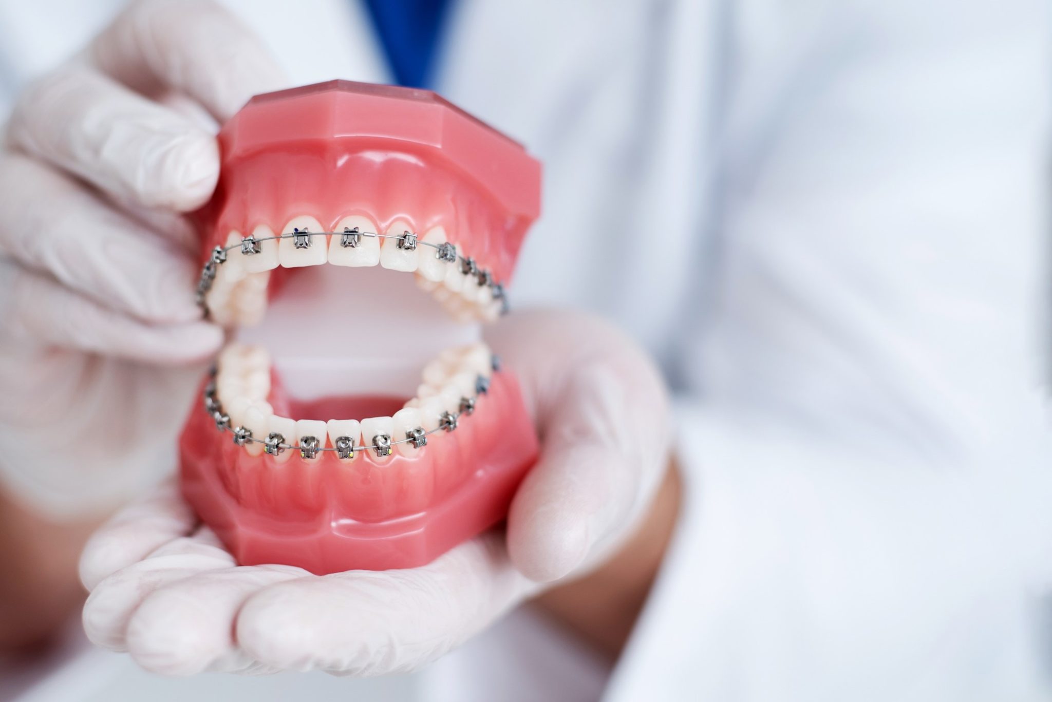 5 Myths About Metal Braces Worcester Orthodontist Super Braces