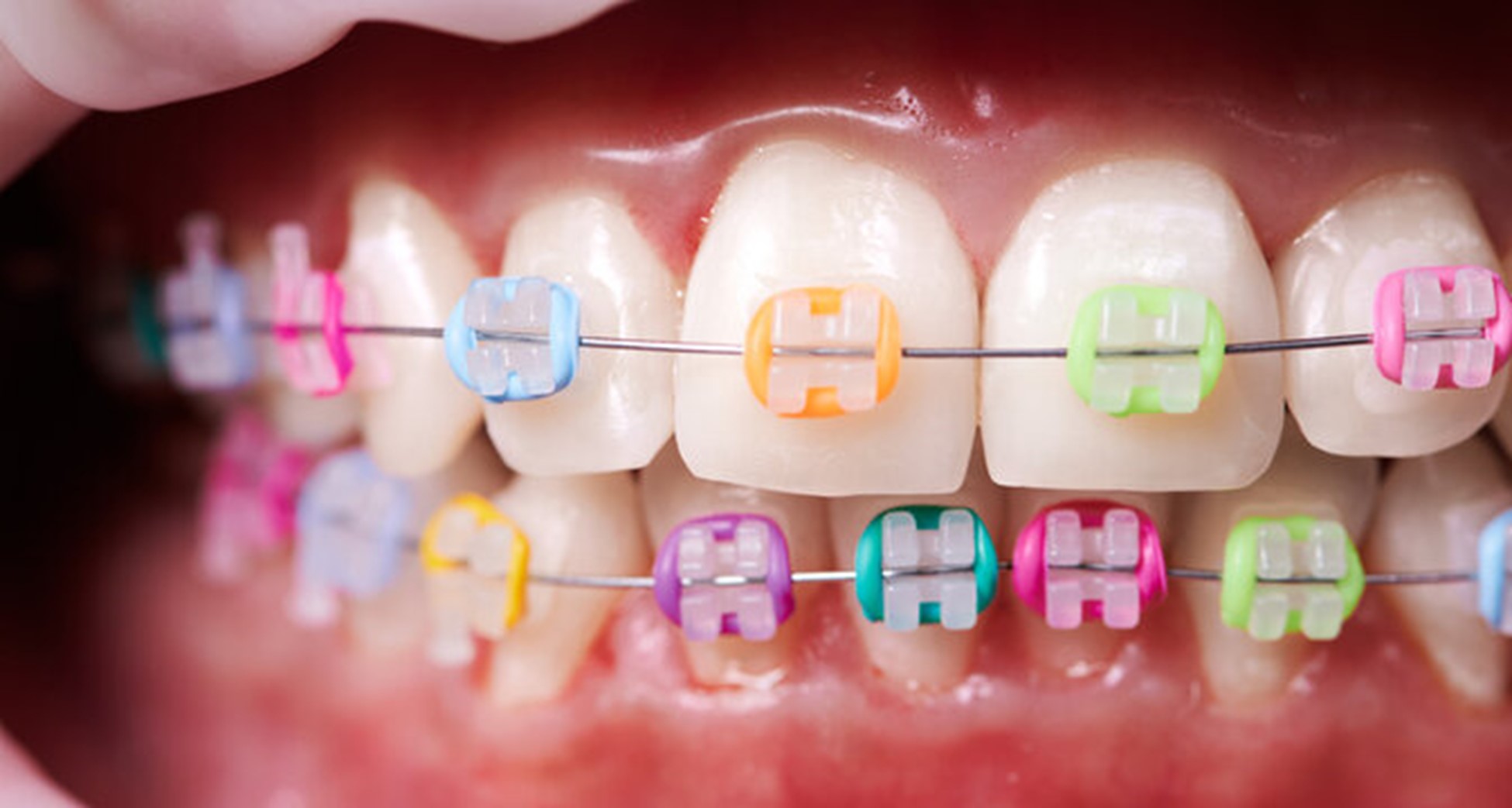 What Are Elastics (Rubberbands) and How Do They Help With My Braces? –  Braces For U